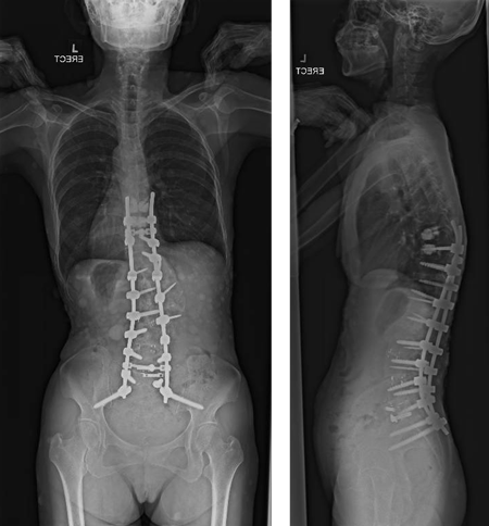 2-year follow-up postoperatively:
