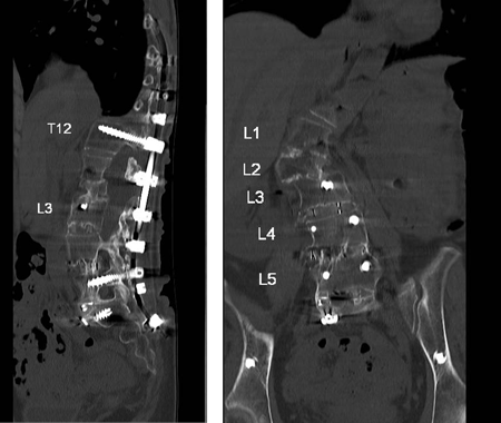 Postoperative CT scan demonstrated successful fusion