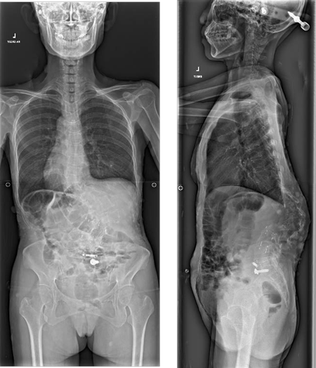 Postoperative finding