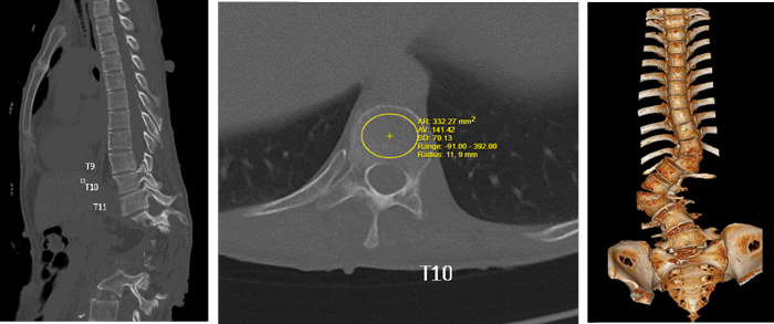 Preoperative CT scan