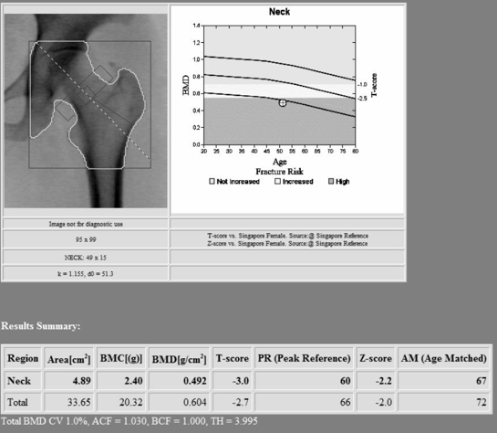 Preoperative BMD
