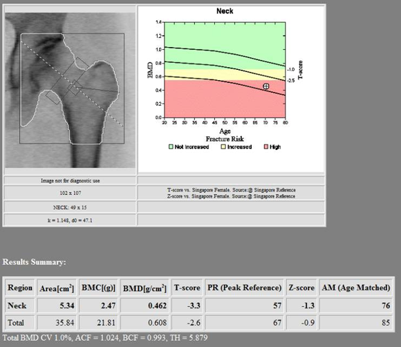 Preoperative BMD