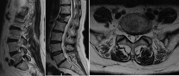 Preoperative MRI