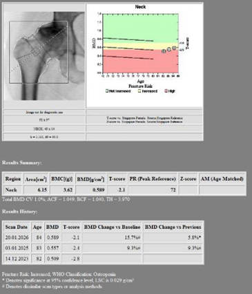 Right Hip BMD After Denosumab Initiation