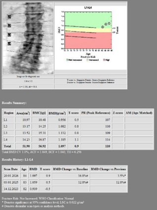 Spine BMD After Denosumab Initiation